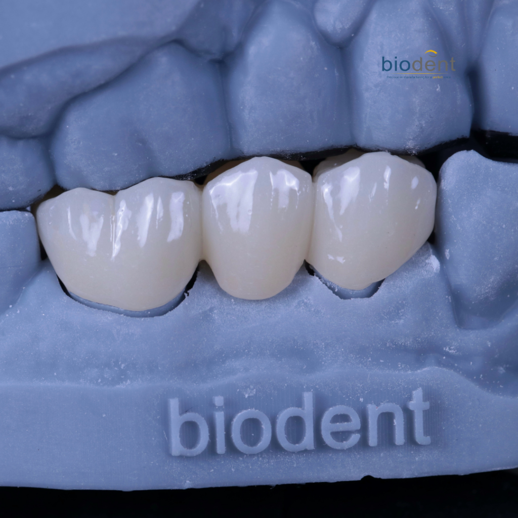 Implant supported screw retained- zirconia