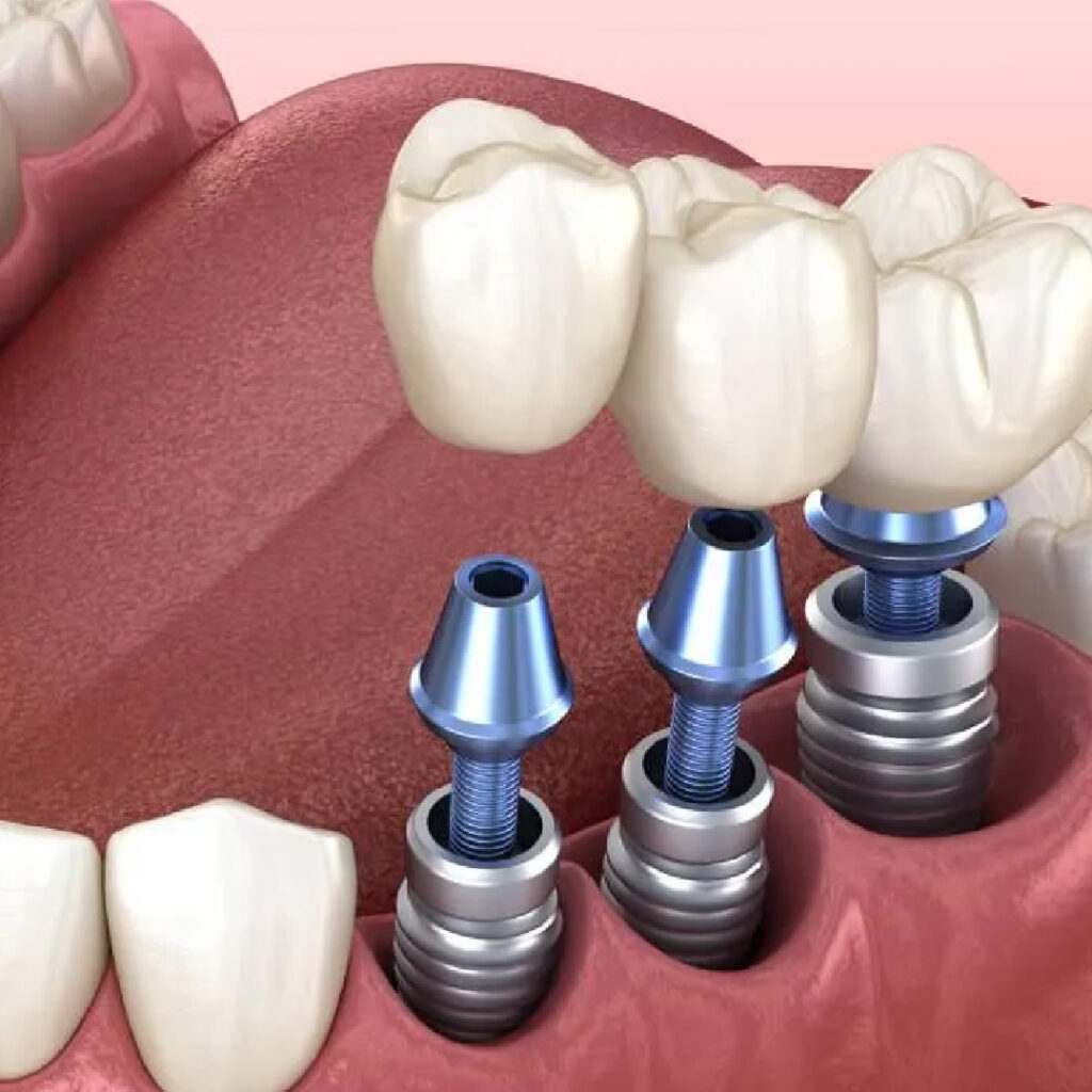 Biodent Implants-01