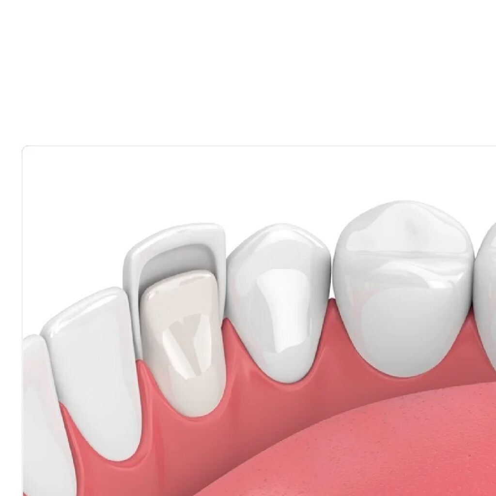 VENEERS-01