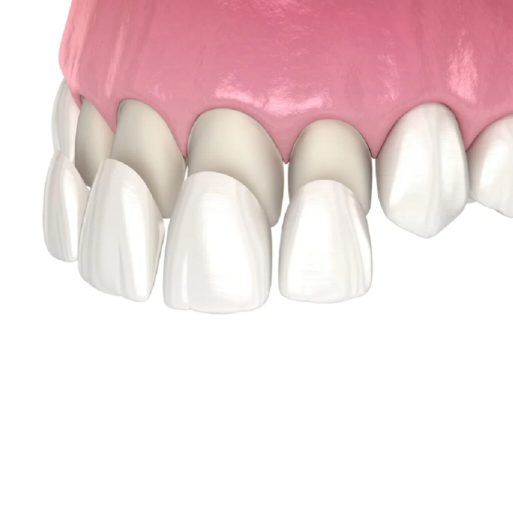 VENEERS-04